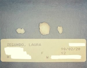 Photo of 3 elbow joint bone fragments set against a light blue material. Below them, the patient's info "Segundo, Laura," the date of the surgery and the age of the patient, "12."